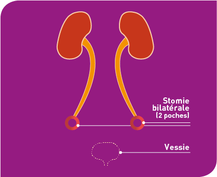 schma_stomie_bilatrale image Urétérostomie cutanée directe