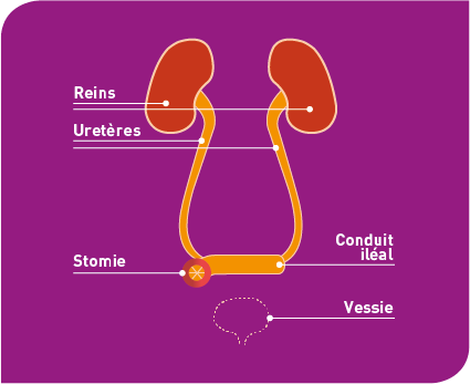 schma_urostomie image Urétérostomie cutanée trans-iléale de type Bricker