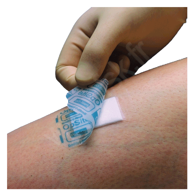 Pansement Opsite post-op
